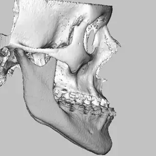 vsp orthognathics scans occlusal surface