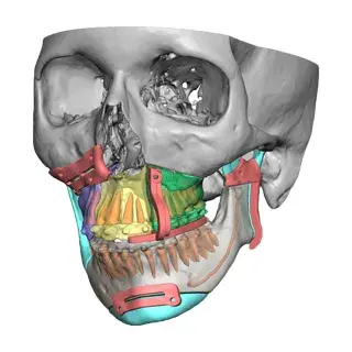 vsp orthognathics marking iso
