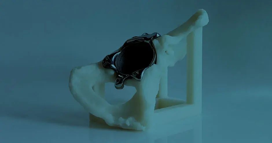 3Dプリントしたメタル部品の医療用モデル