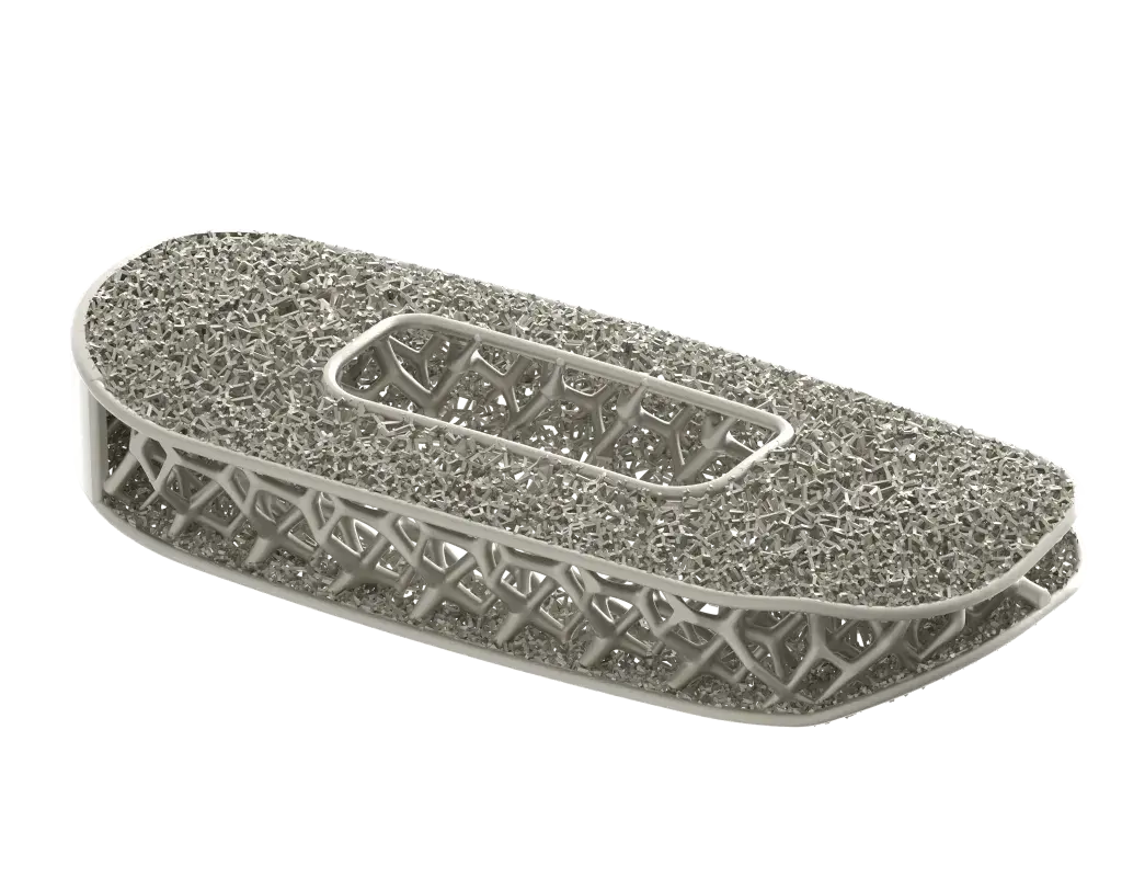 3D プリントを使用して製造された NuVasive 社による最適化された脊椎インプラント