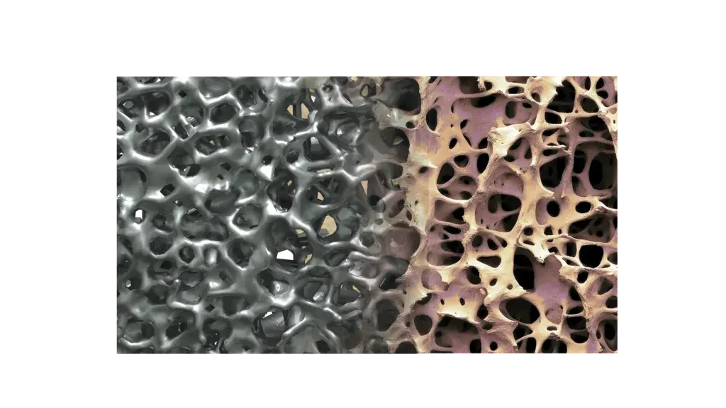 NuVasive 社の Modulus ラインの脊椎インプラントの設計は、脊椎インプラント患者の臨床成果を向上させるために設計されています。