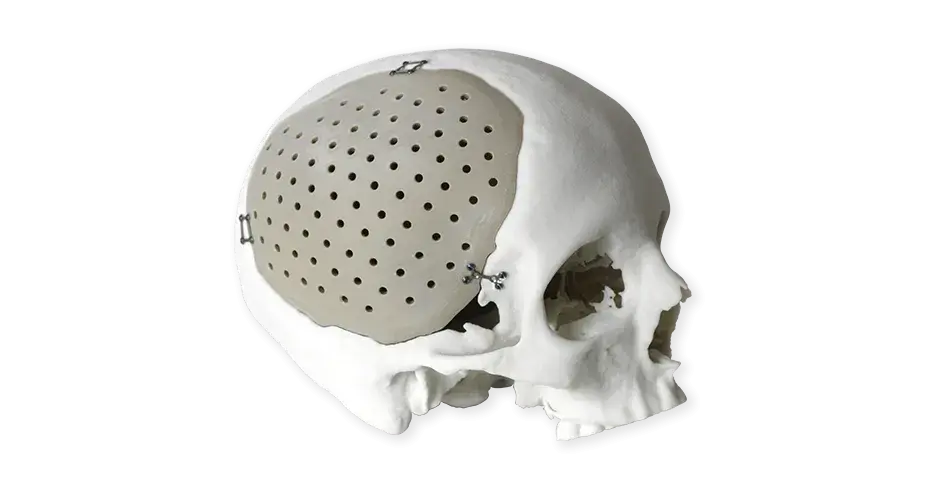 PEEK 頭蓋インプラント