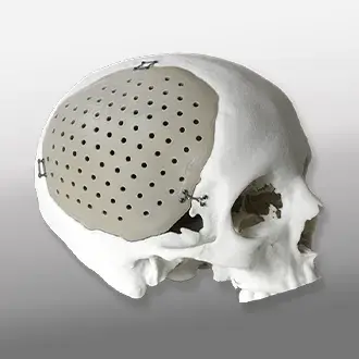 a skull with a 3D printed cranial plate