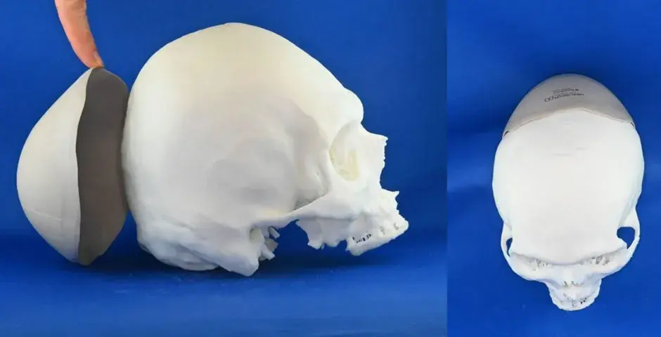 A 3D printed implant that was placed directly on the skull to reconstruct the missing shape of someone's skull.