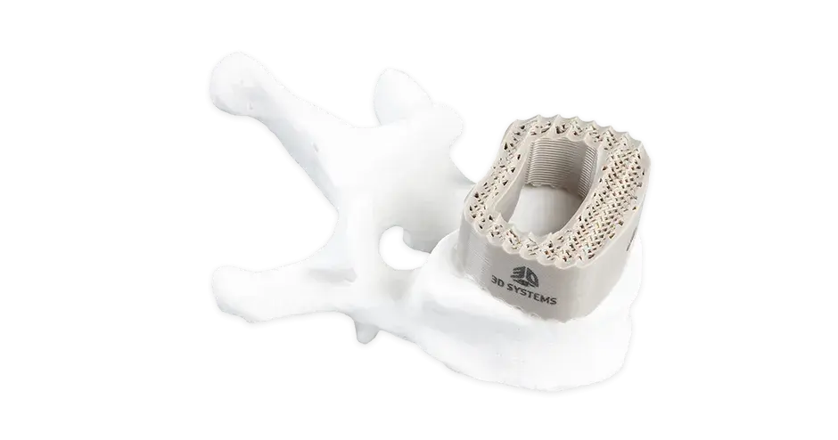 3D printed spinal cage PEEK