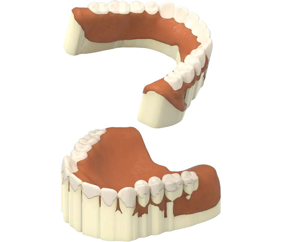 NextDent プロダクション リムーブ サポート