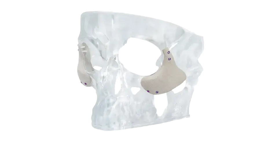 フェイシャルインプラント