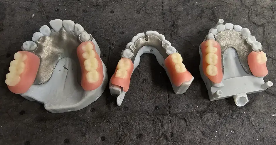 3D プリント義歯