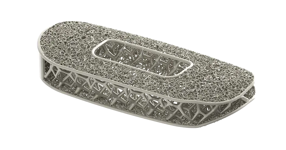 3D プリントを使用して製造された NuVasive 社による最適化された脊椎インプラント 